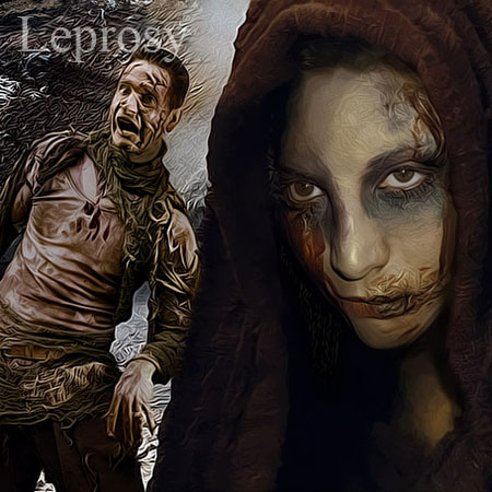 Leprosy